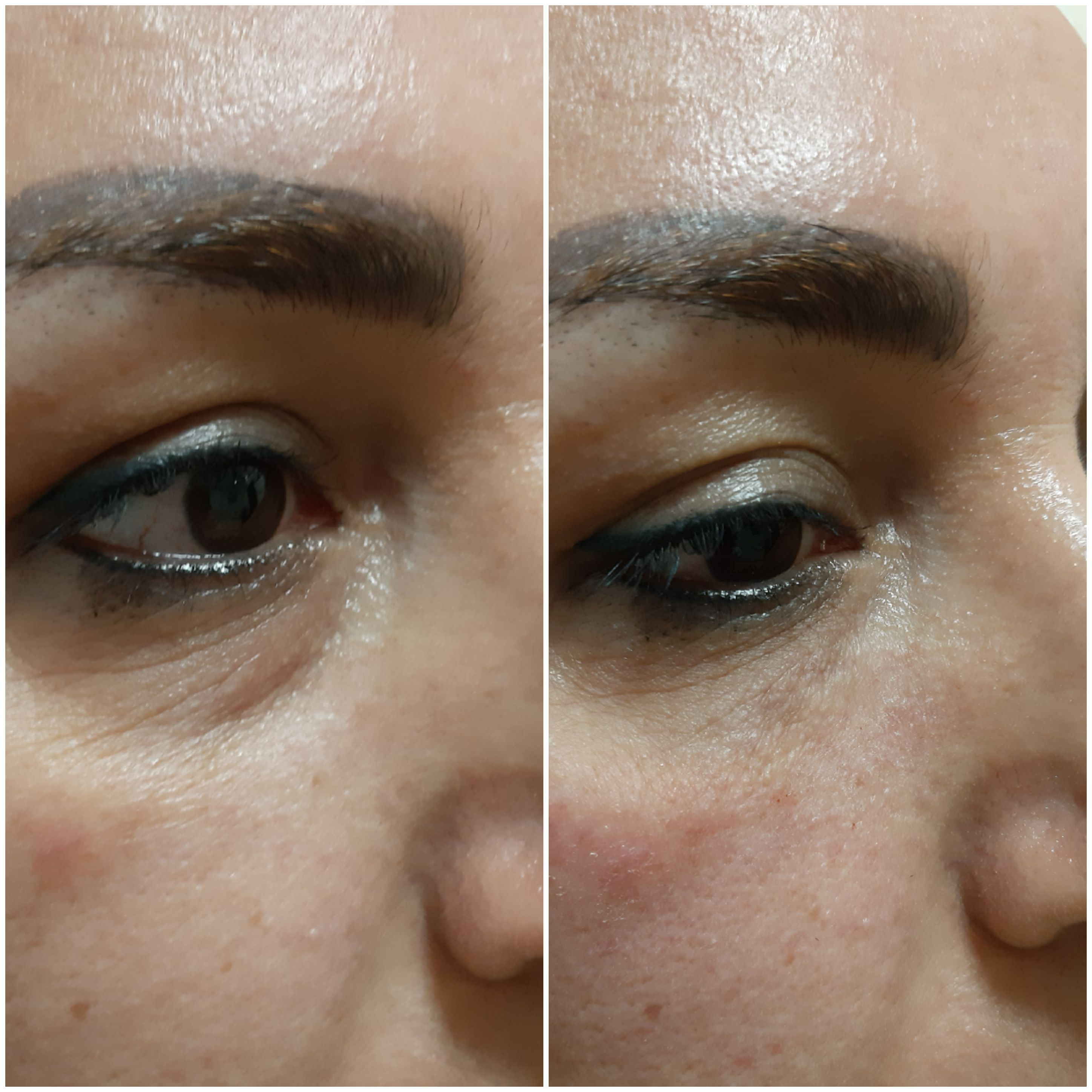 Undereye groove correction