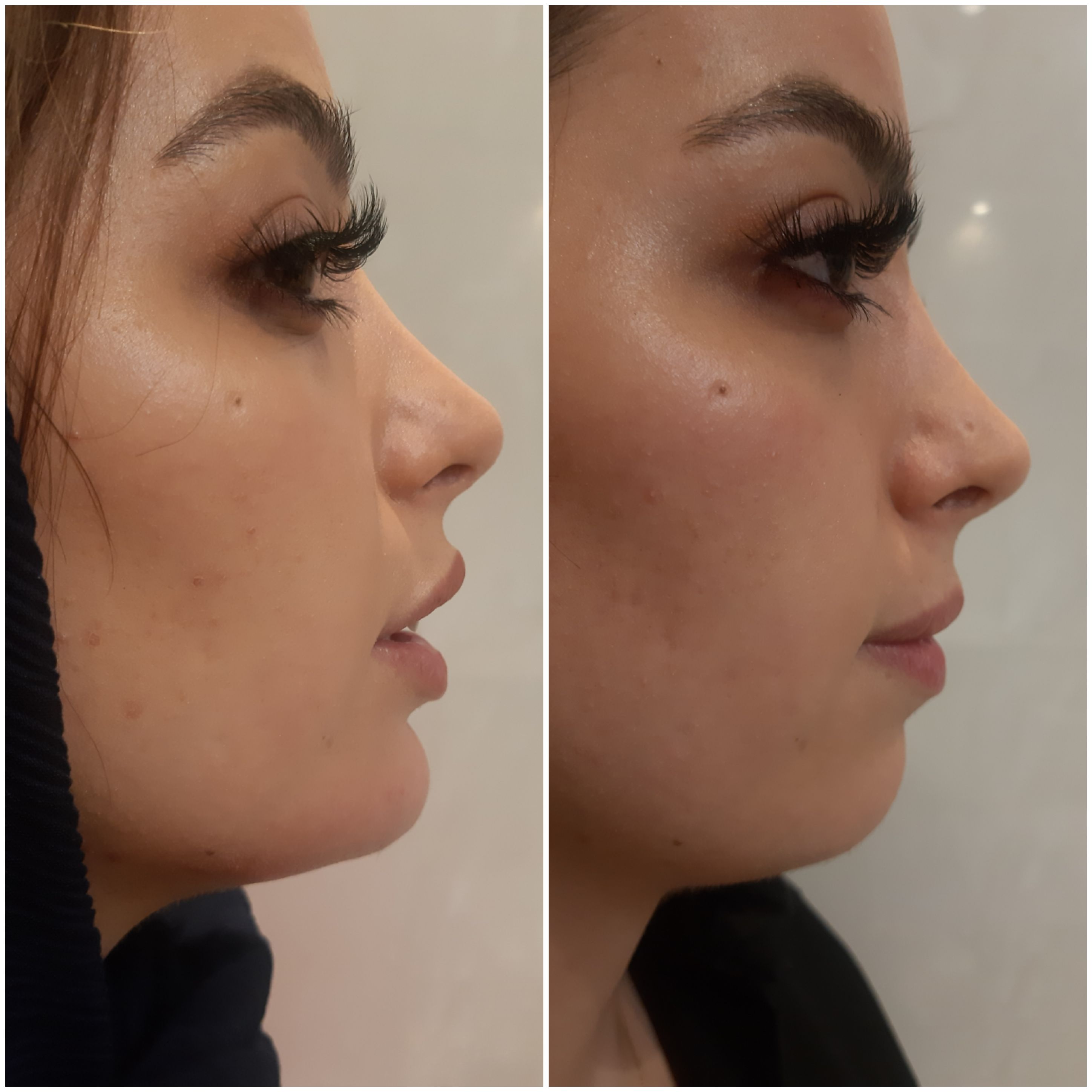 Chin correction