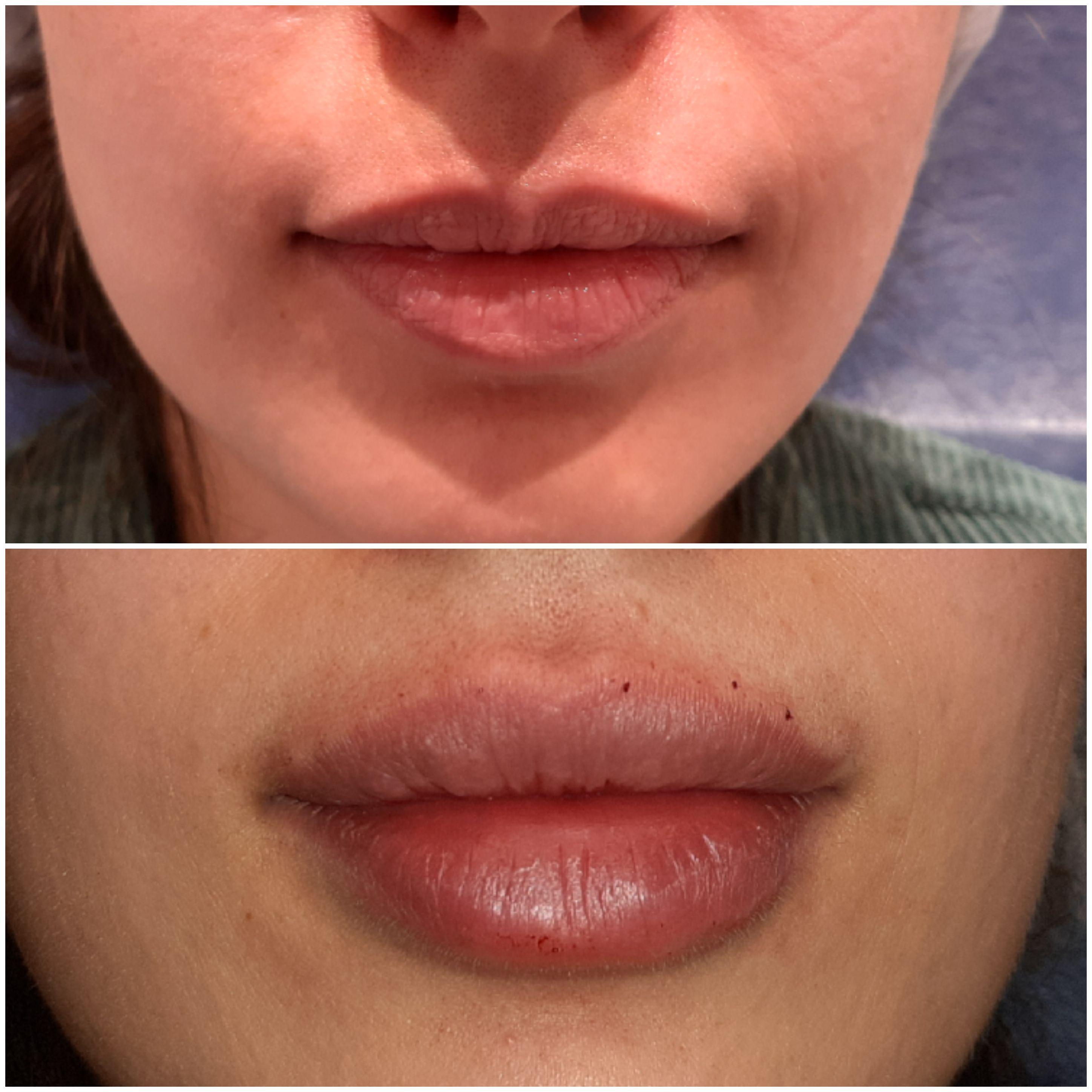 Lip augmentation