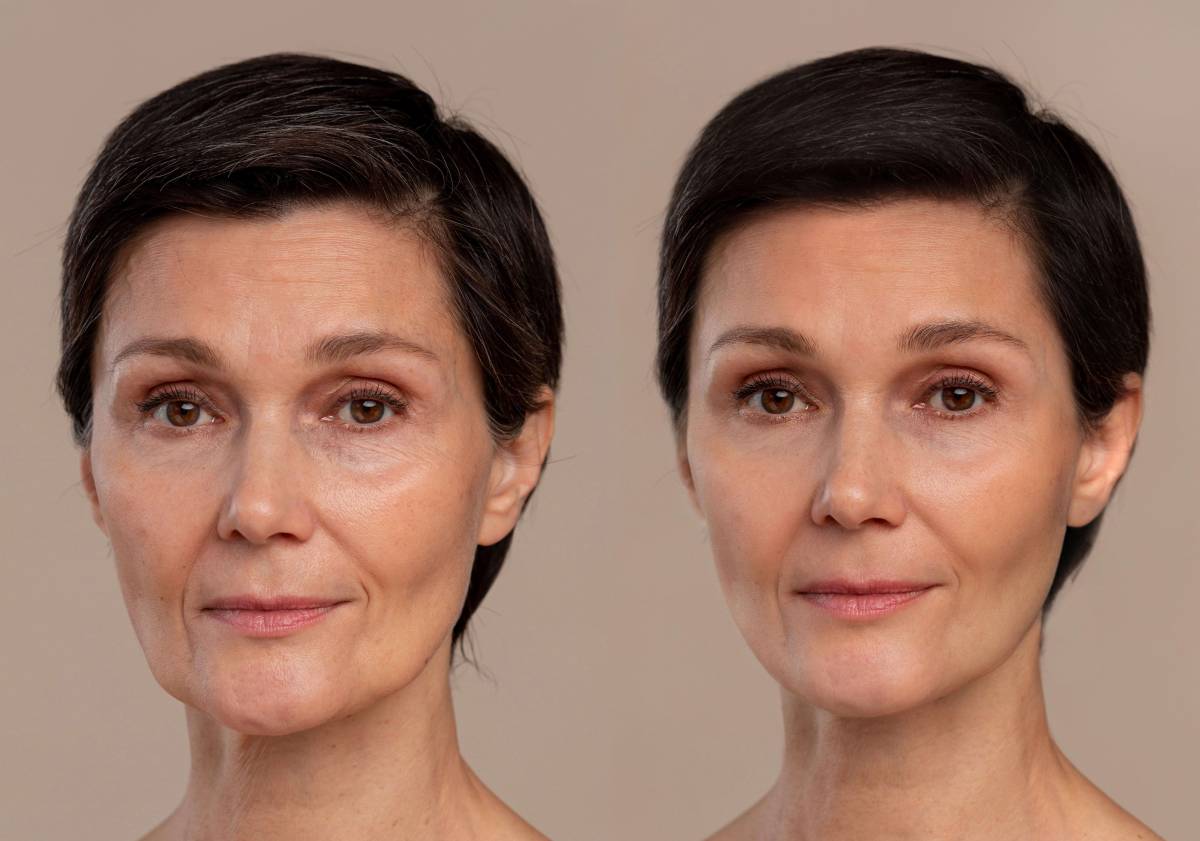 frown line treatment before and after