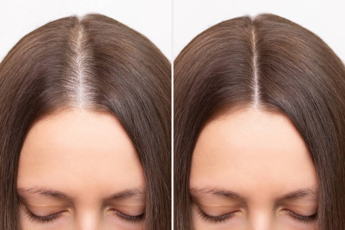 hair loss before and after