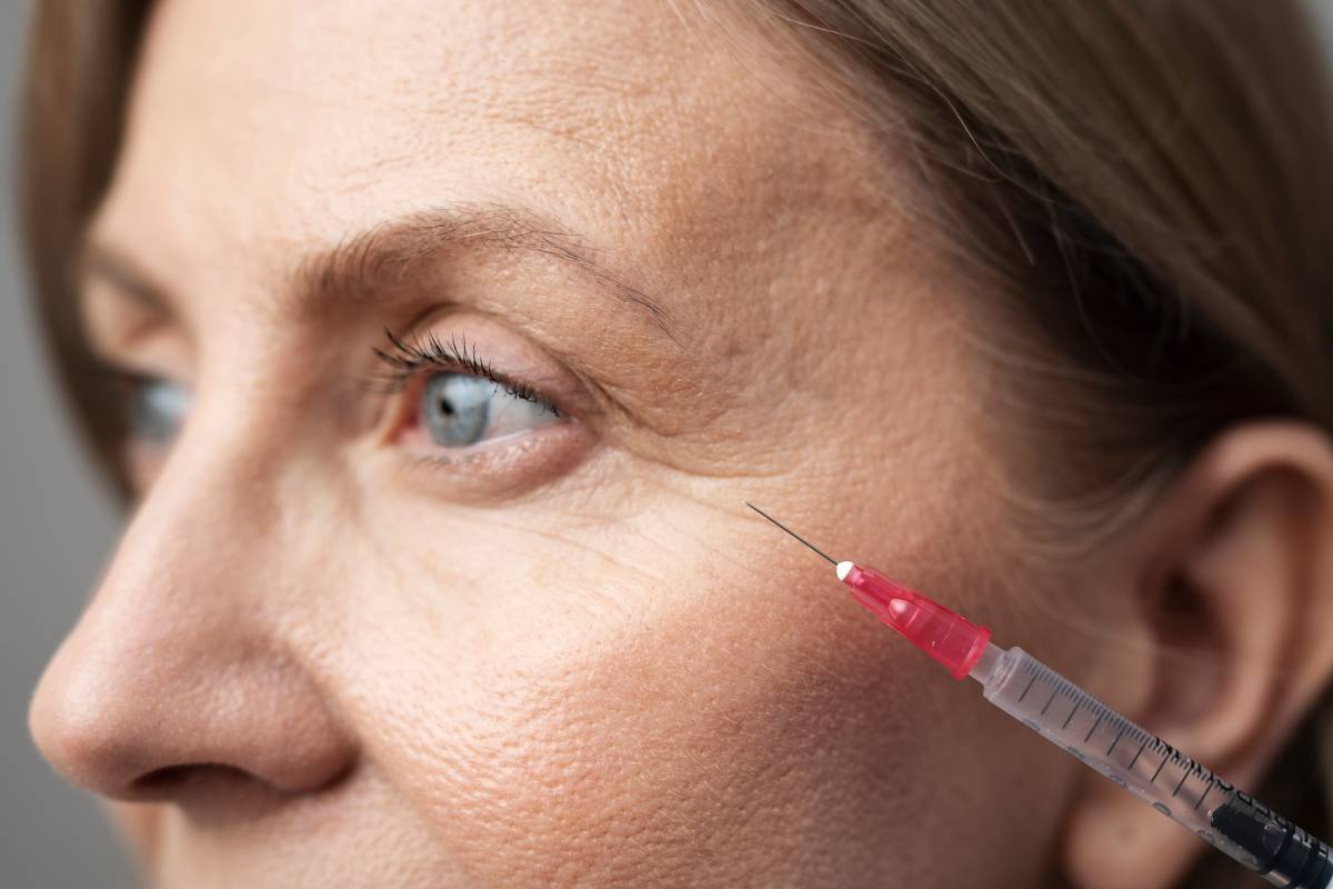 Crows Feet Correction with Botox 