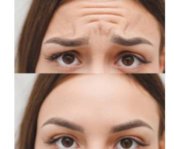 frown lines botox treatment