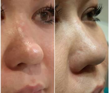 nose filler treatment