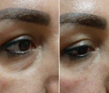 under eye filler treatment