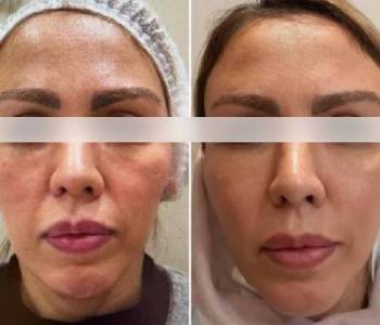 cheek filler treatment