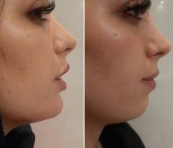 chin filler treatment