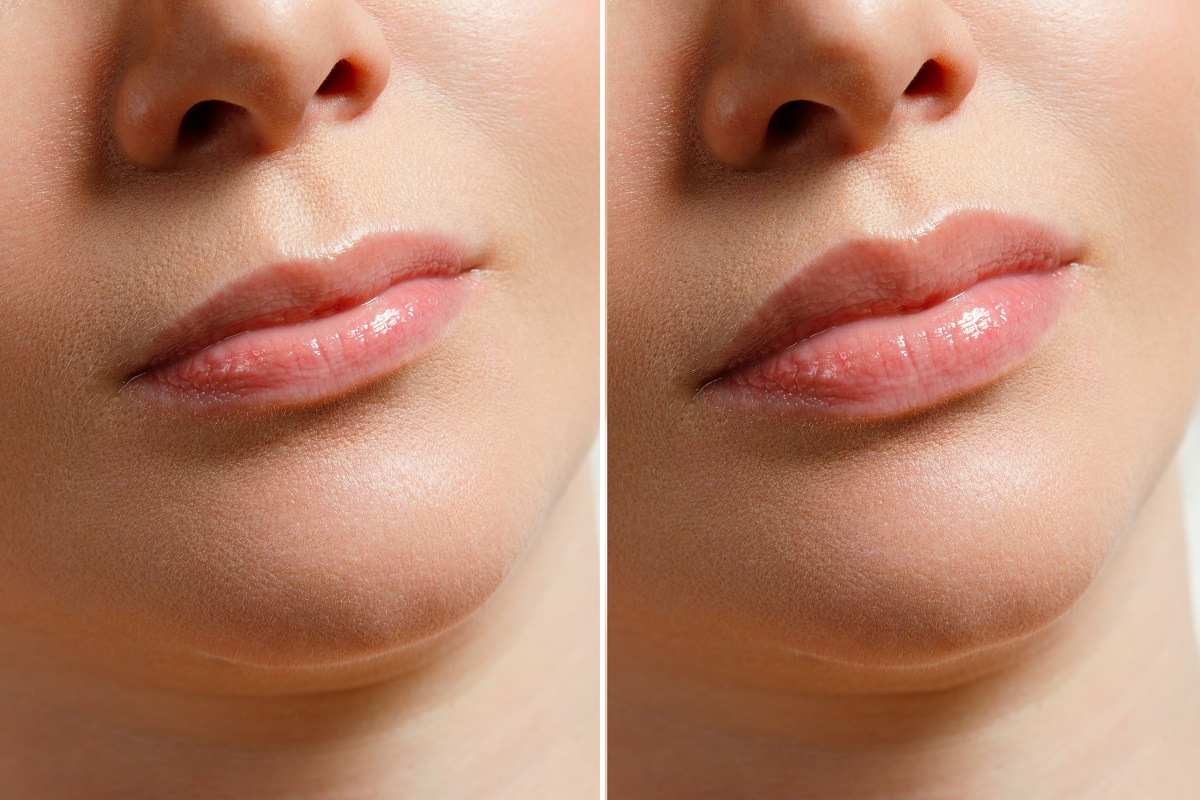 lip filler treatment Thornhill