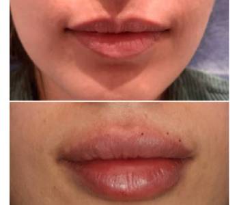 lip filler treatment