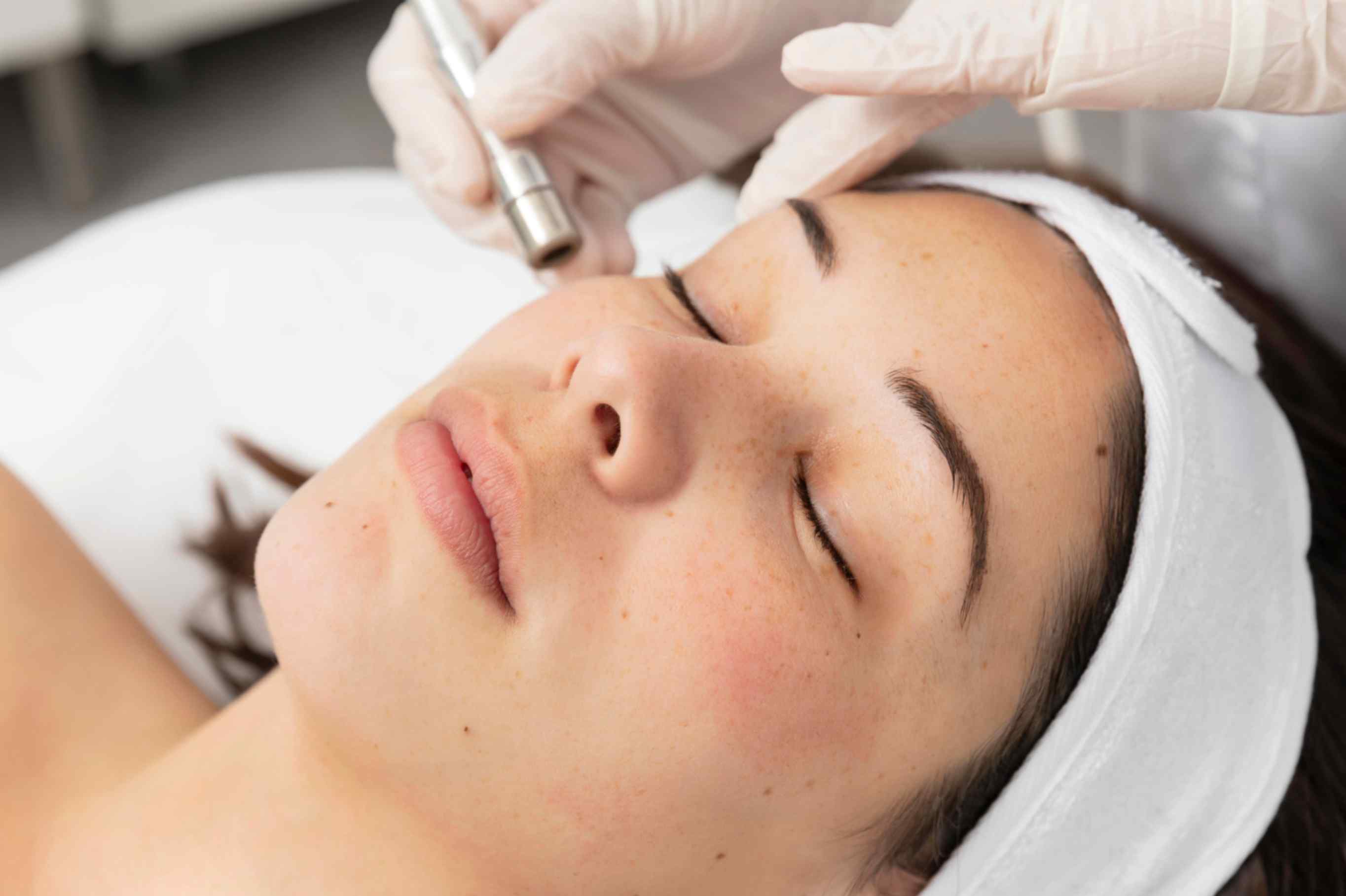 Top Microneedling Clinics in Whitby, ON