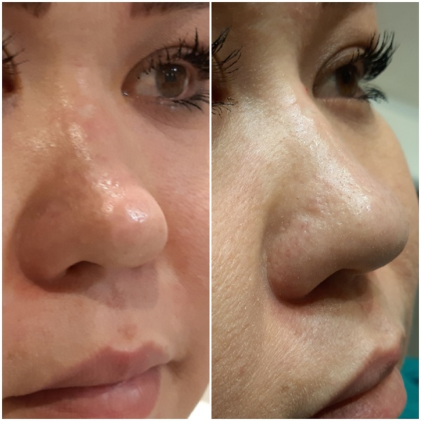 Nose deformity correction