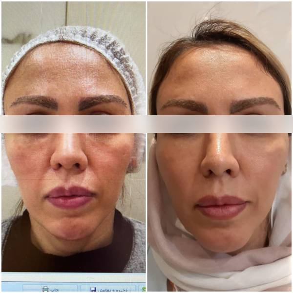 Cheek augmentation