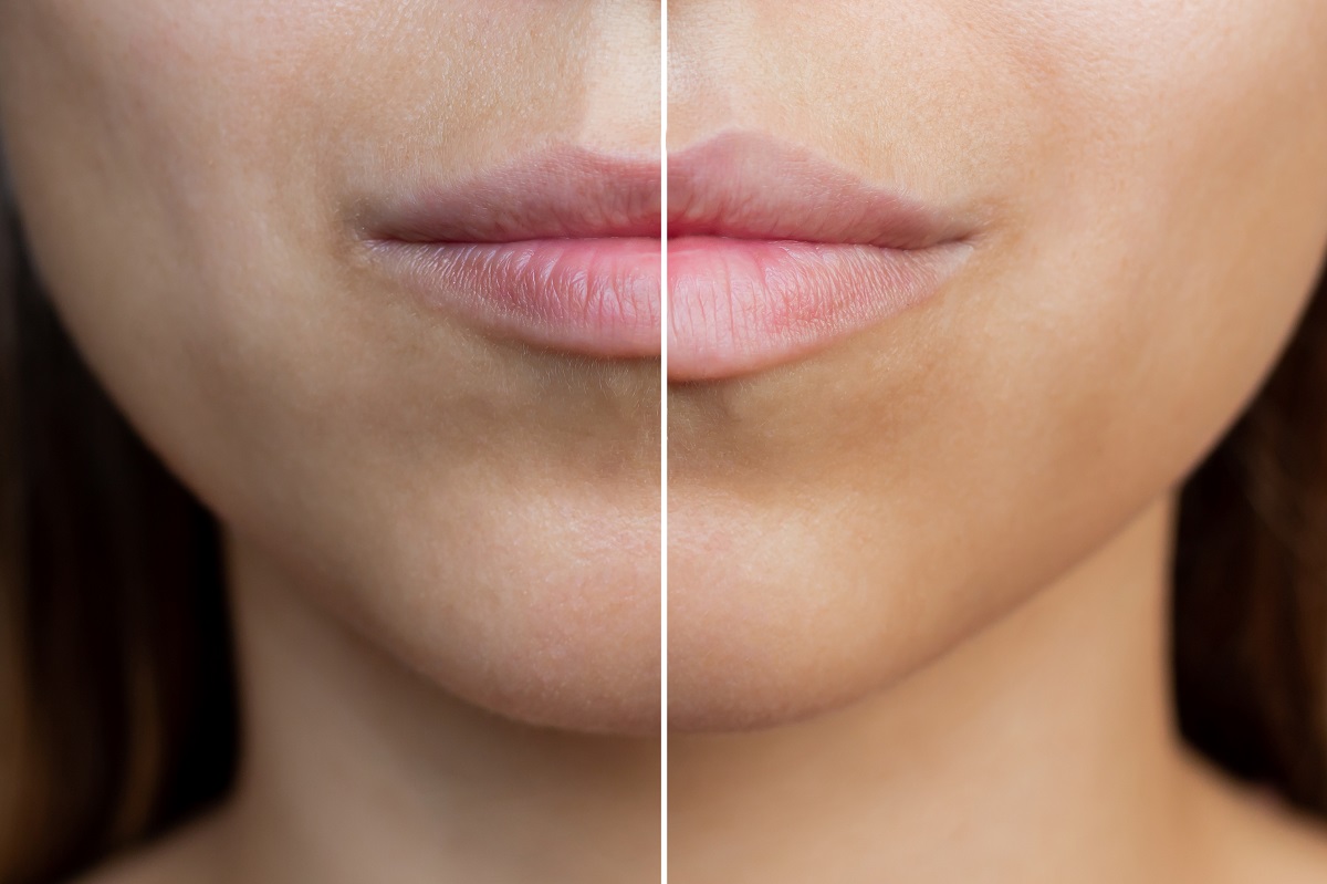 Before and after lip injection