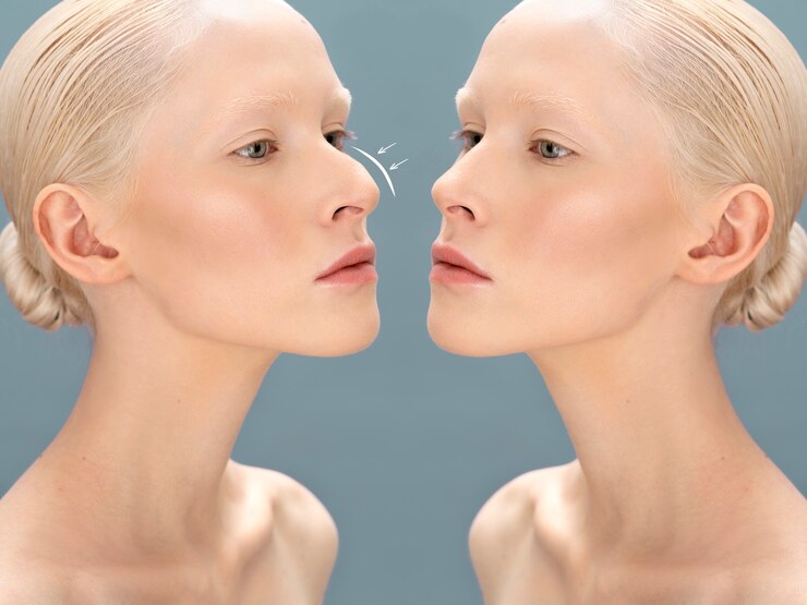 Non Surgical Rhinoplasty for Nose