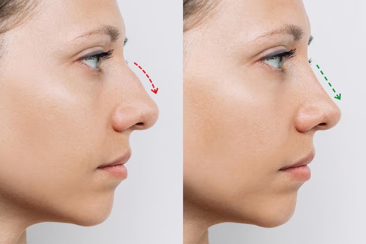 Nose Deformity Treatment Before and After