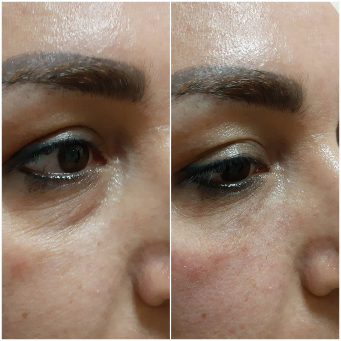 Undereye Grooves Treatment